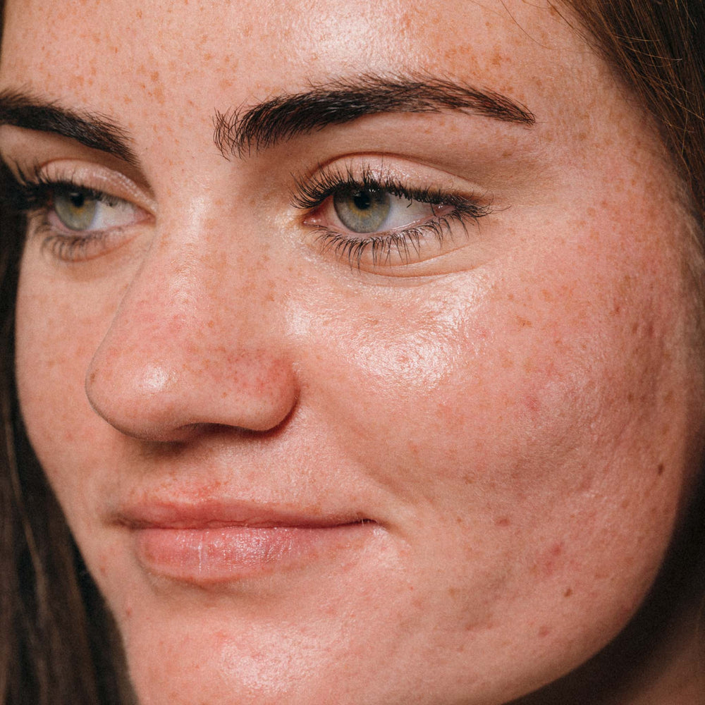 Close-up of a person's face with visible freckles and skin texture.