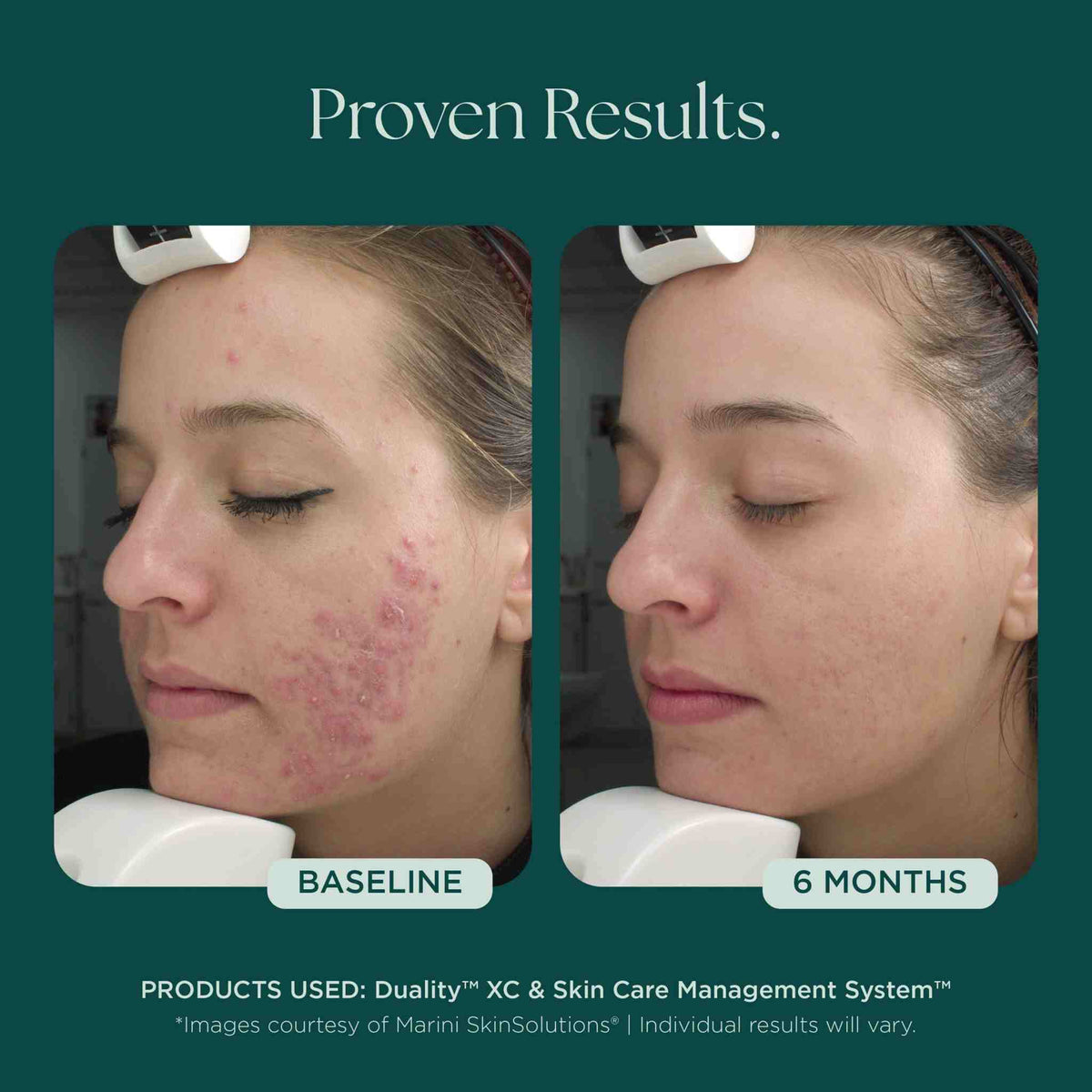 Duality XC before and after – baseline vs 6 months
